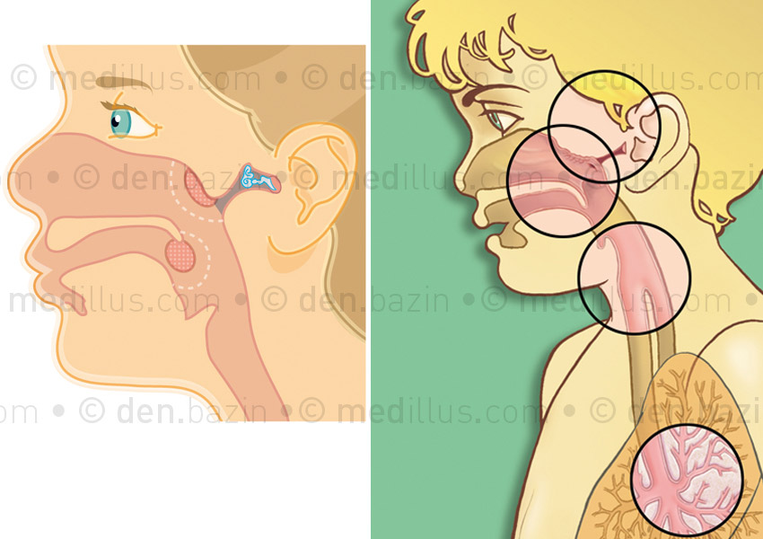 Végétations et localisation d'infections