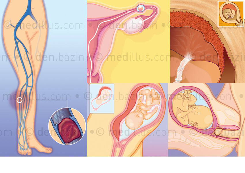 Phlébite, grossesse extra-utérine, décollement, placenta praevia, rapport