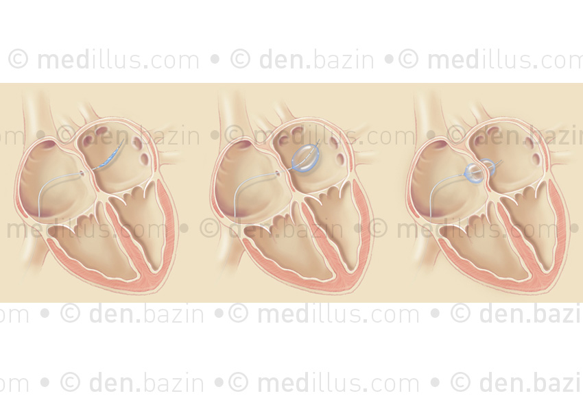 Maintien de la communication interauriculaire par chirurgie des ballonnets