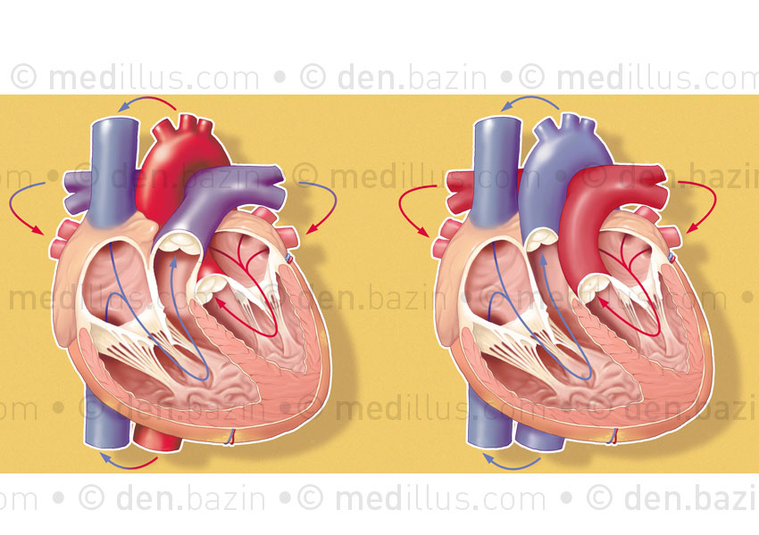 Cœur normal et transposition des gros vaisseaux