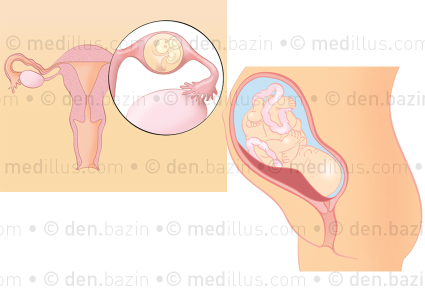 Grossesse extra-utérine et placenta praevia