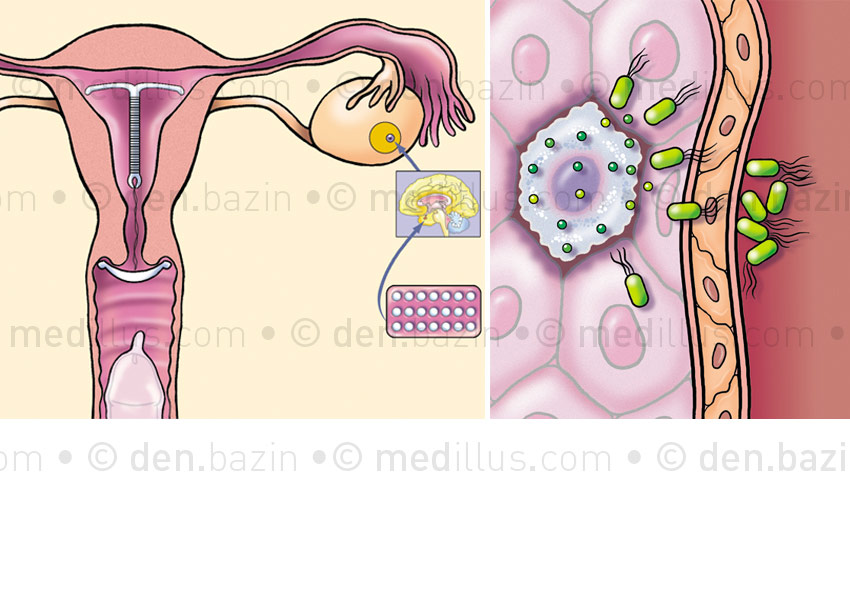 Contraception et infection