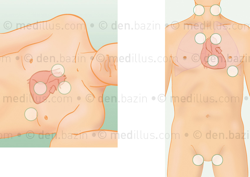 Auscultation pulmonaire