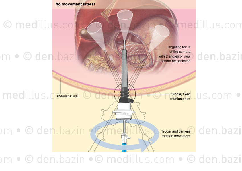 Rotation du trocard