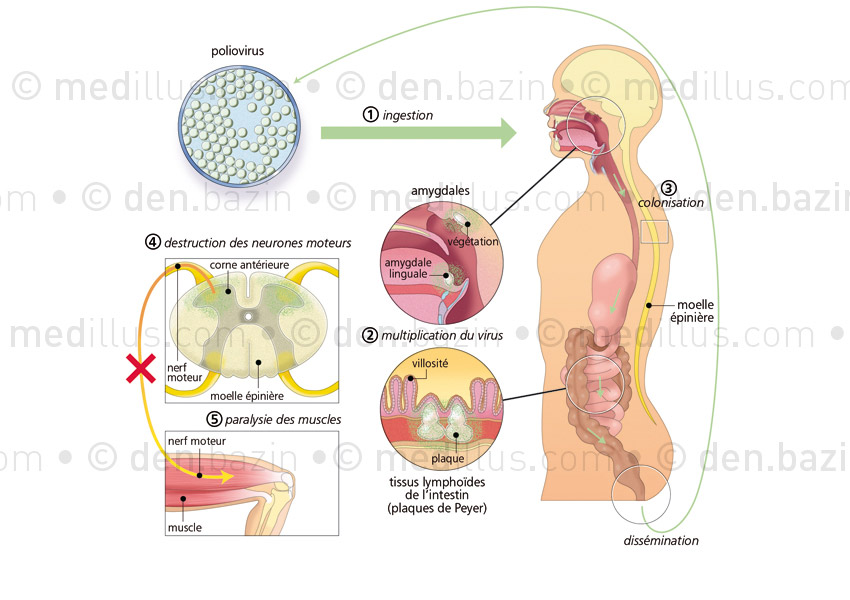 Atteintes de la poliomyélite