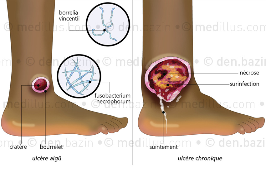 Ulcère phagédénique
