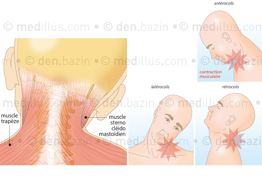 Torticolis et autres dystonies