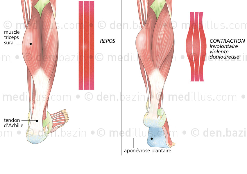 Crampe musculaire