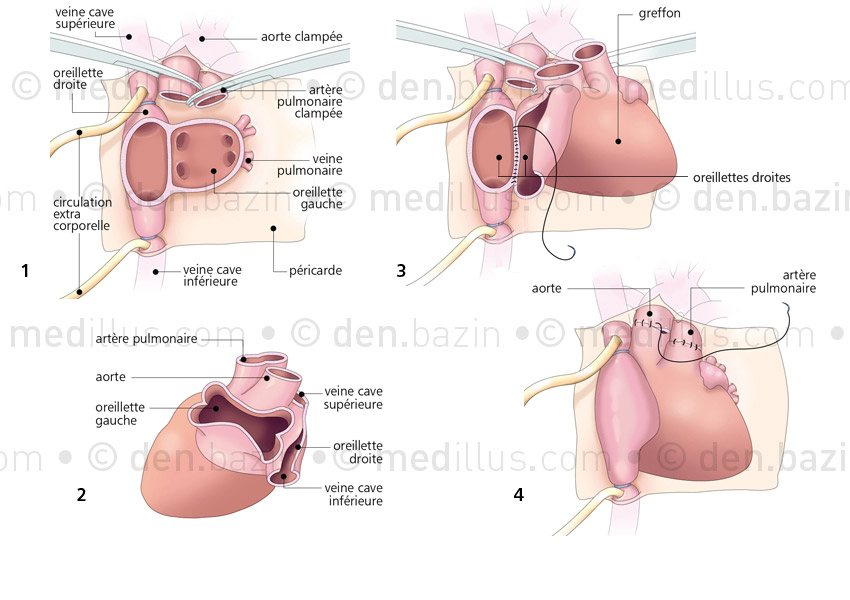 Transplantation cardiaque