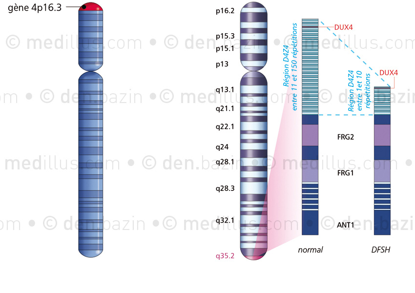 Gènes du nanisme et de la dystrophie FSH sur le chromosome 4