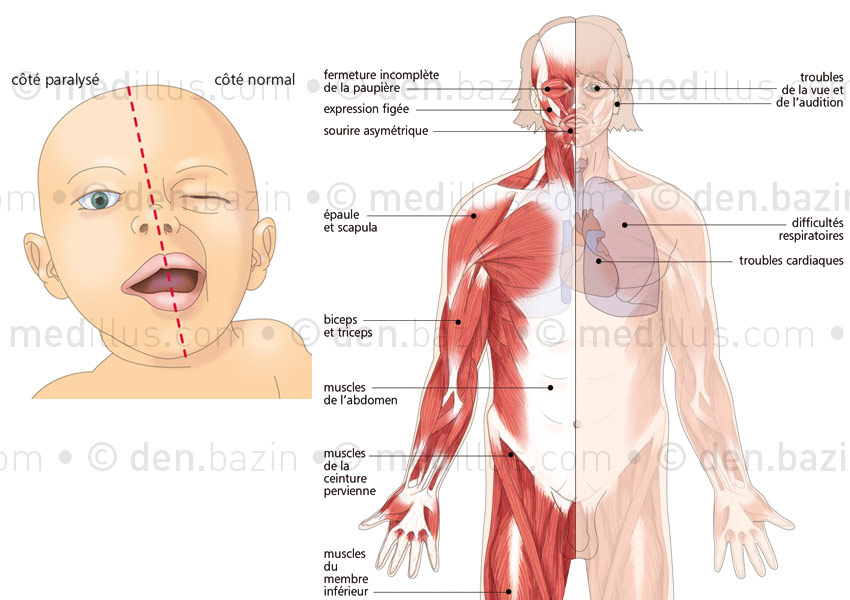 Diplégie fasciale et localisation des dystrophies FSH