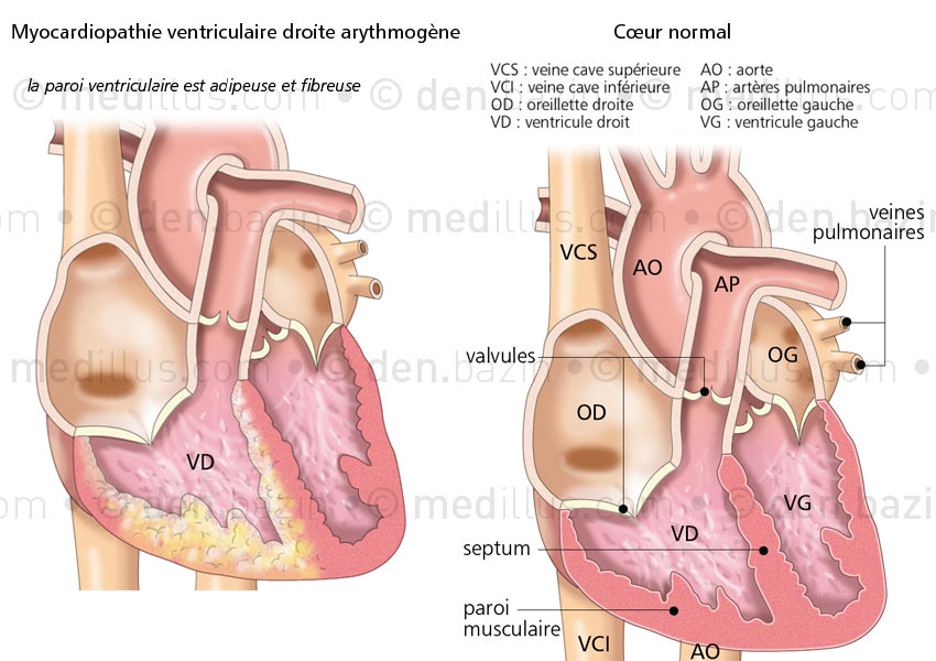 Myocardiopathie et cœur normal