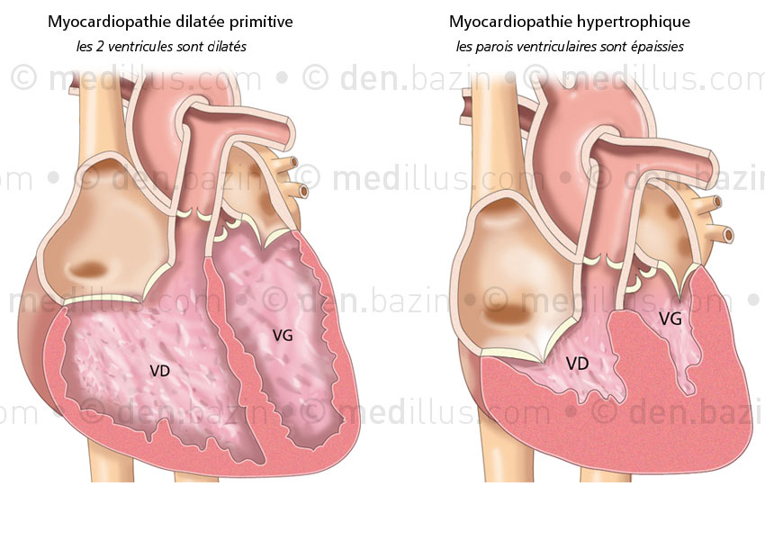 Autres myocardiopathies