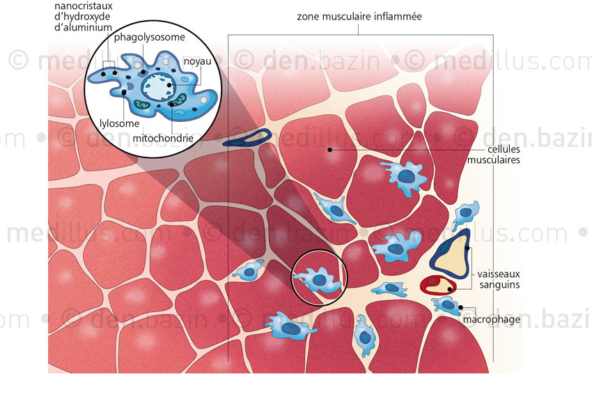 Histologie de la myofasciite