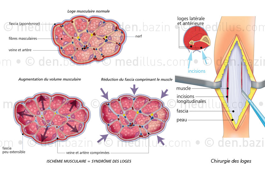 Syndrome des loges et chirurgie