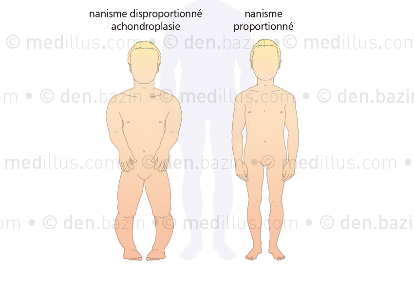 Les deux formes de nanisme