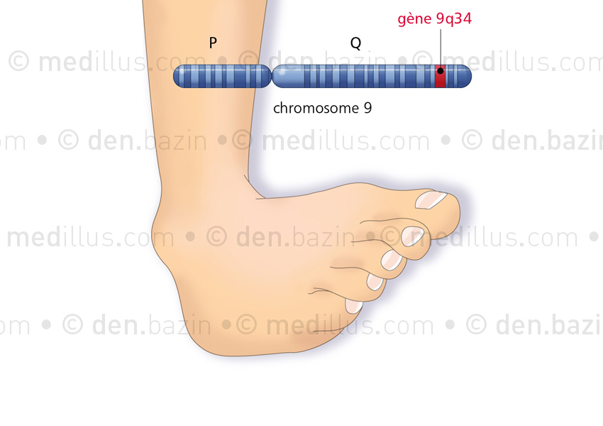 La dystonie idiopathique et son gène sur le chromosome 9