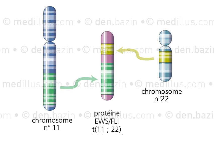 Translocation de gènes dans la maladie d'Ewing