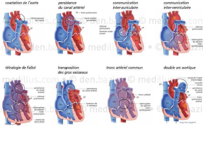 Malformations cardiaques congénitales