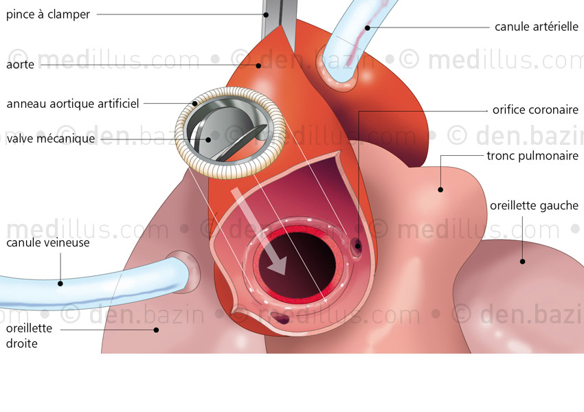 Pose d'une valve aortique artificielle