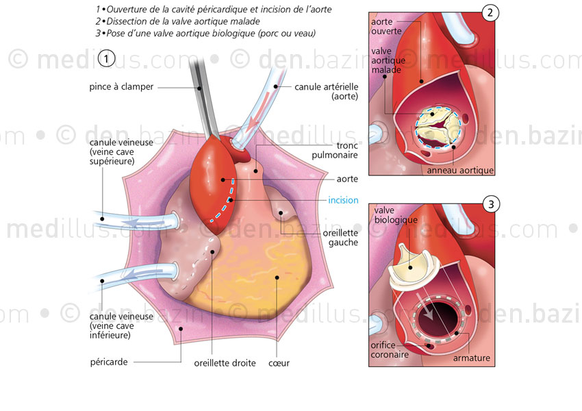 Pose d'une valve aortique naturelle