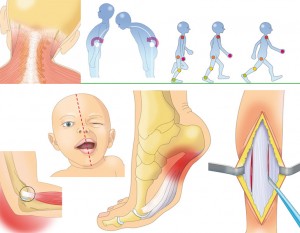 Muscles : maladies, chirurgie, mobilité